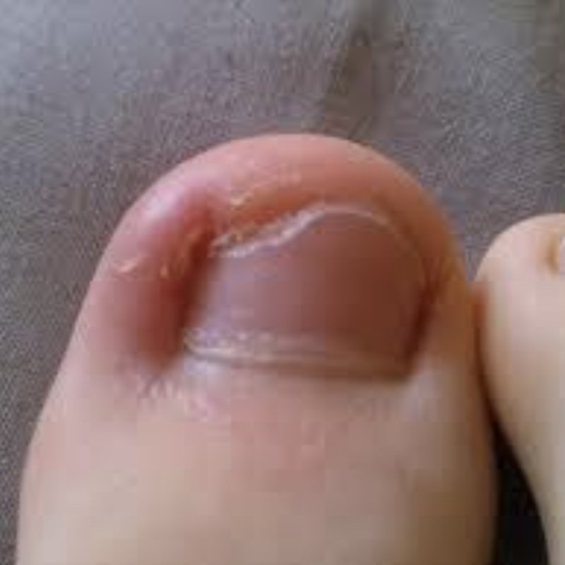 Ongles incarnés